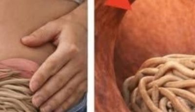 Garlic eliminates parasites in just 1 day? What you really should know before trying it